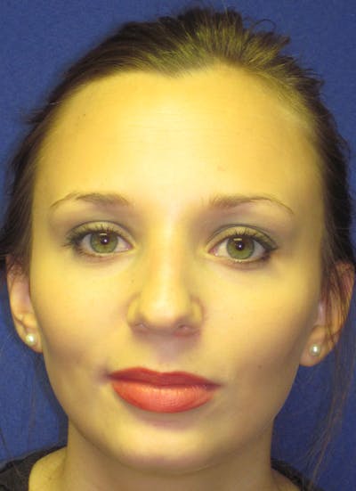 Rhinoplasty Before & After Gallery - Patient 4891310 - Image 1