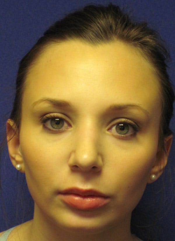 Rhinoplasty Before & After Gallery - Patient 4891310 - Image 2