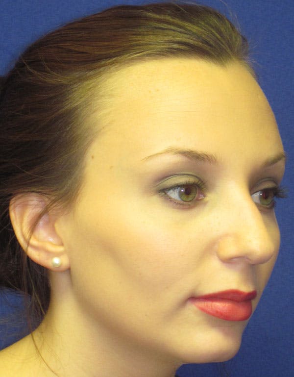 Rhinoplasty Before & After Gallery - Patient 4891310 - Image 3