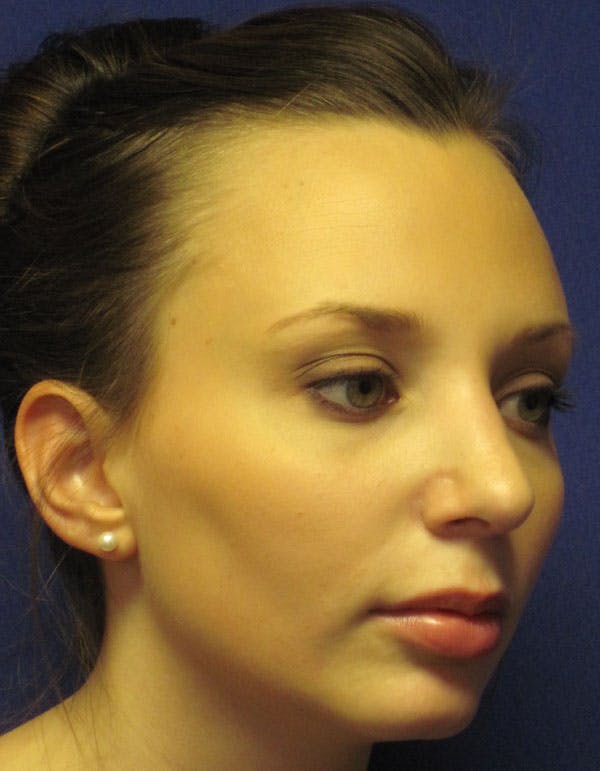Rhinoplasty Before & After Gallery - Patient 4891310 - Image 4