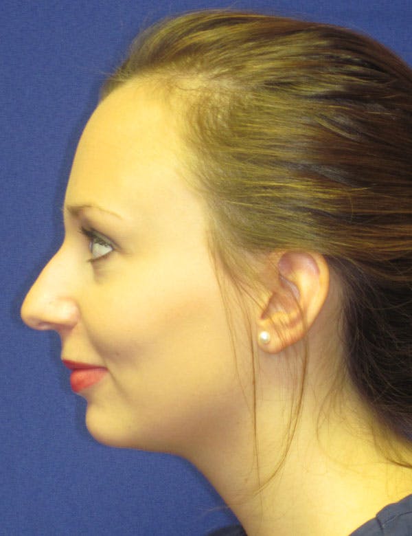 Rhinoplasty Before & After Gallery - Patient 4891310 - Image 5