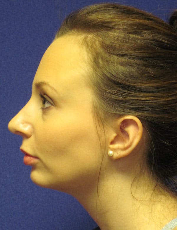 Rhinoplasty Before & After Gallery - Patient 4891310 - Image 6