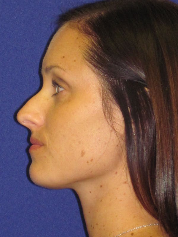Rhinoplasty Before & After Gallery - Patient 4891311 - Image 1
