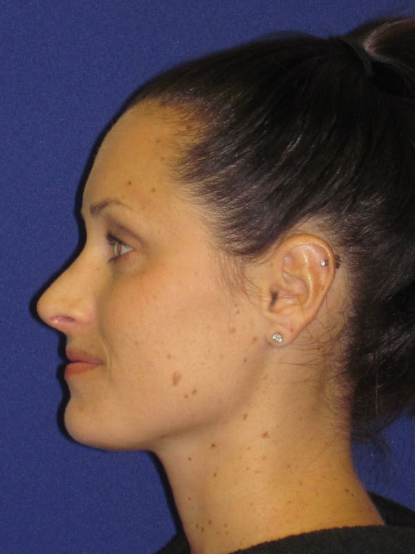 Rhinoplasty Before & After Gallery - Patient 4891311 - Image 2