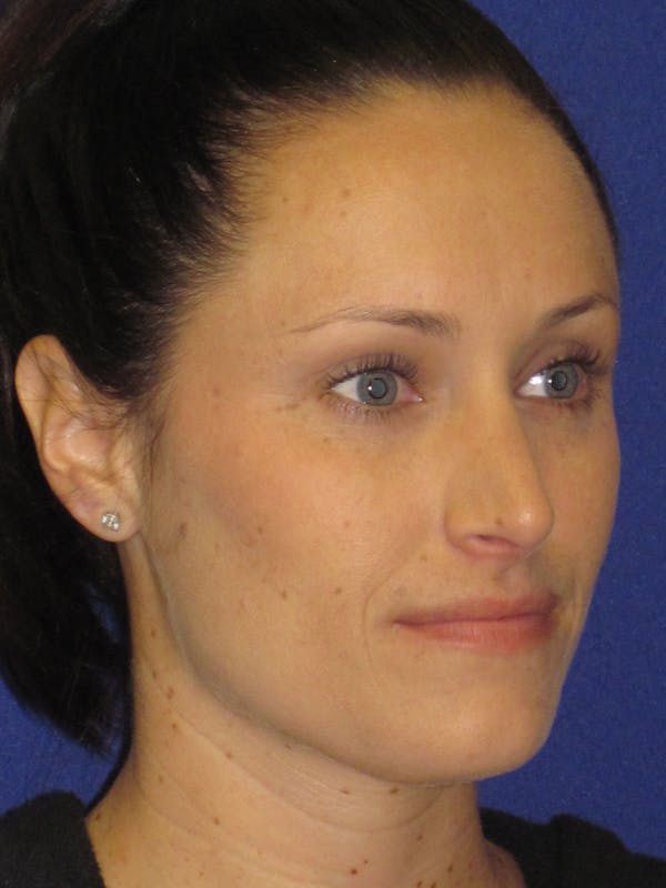 Rhinoplasty Before & After Gallery - Patient 4891311 - Image 4