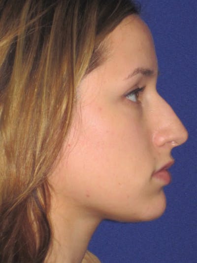 Rhinoplasty Before & After Gallery - Patient 4891313 - Image 1