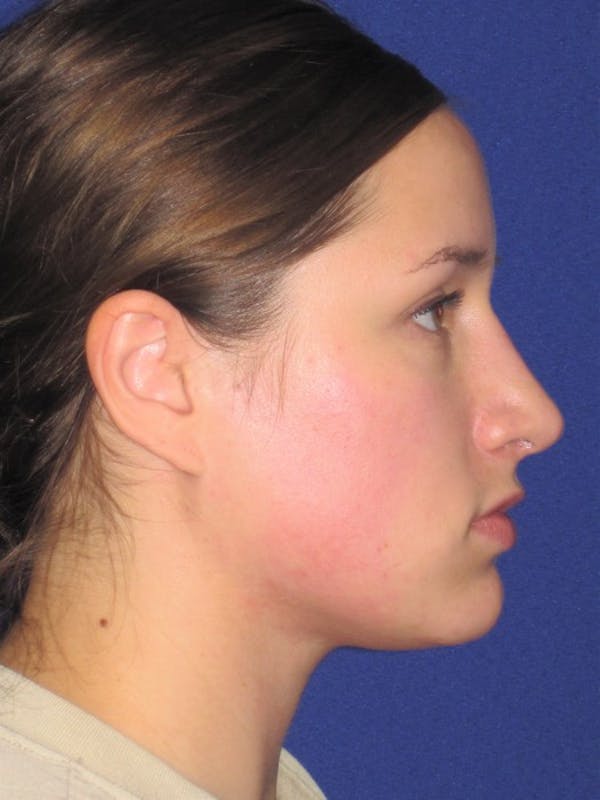 Rhinoplasty Before & After Gallery - Patient 4891313 - Image 2