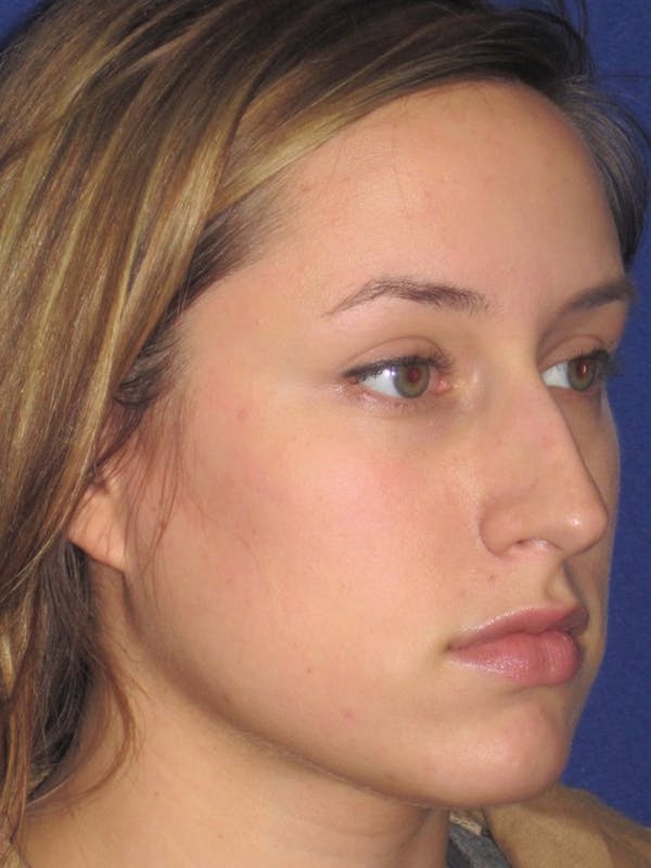 Rhinoplasty Before & After Gallery - Patient 4891313 - Image 3