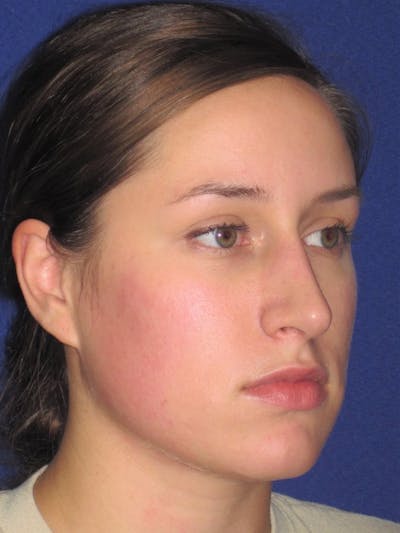 Rhinoplasty Before & After Gallery - Patient 4891313 - Image 4