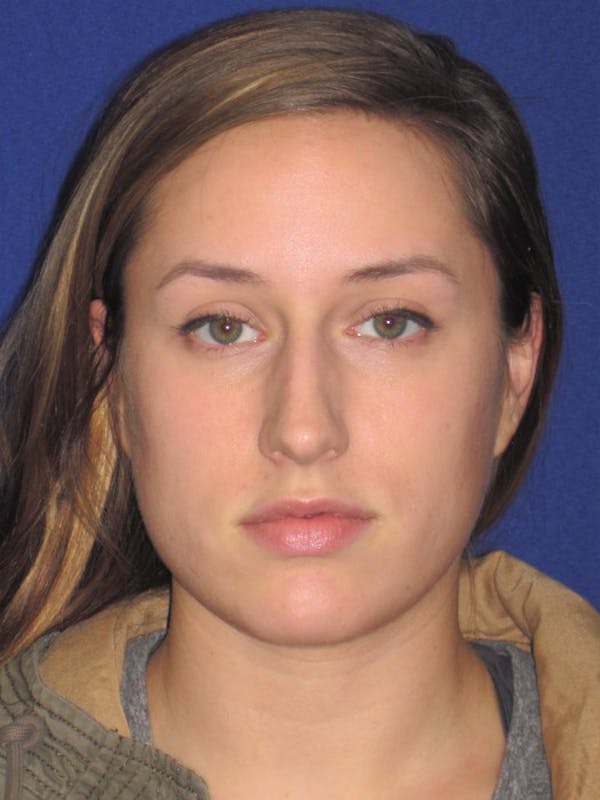 Rhinoplasty Before & After Gallery - Patient 4891313 - Image 5