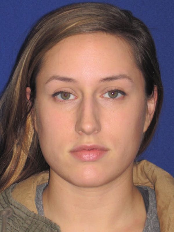 Rhinoplasty Gallery - Patient 4891313 - Image 5