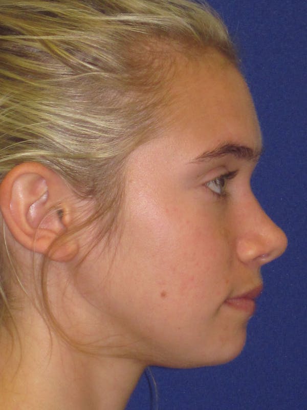 Rhinoplasty Before & After Gallery - Patient 4891317 - Image 3