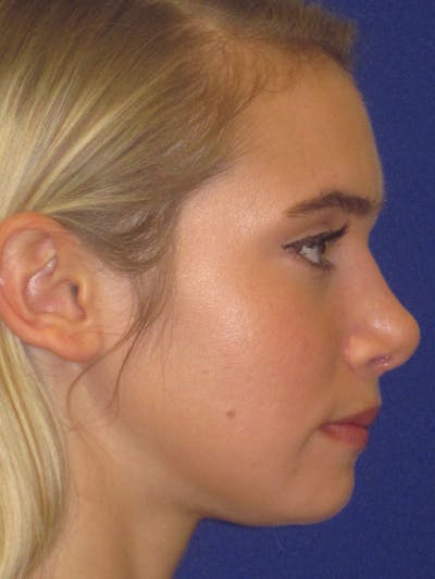 Rhinoplasty Before & After Gallery - Patient 4891317 - Image 4