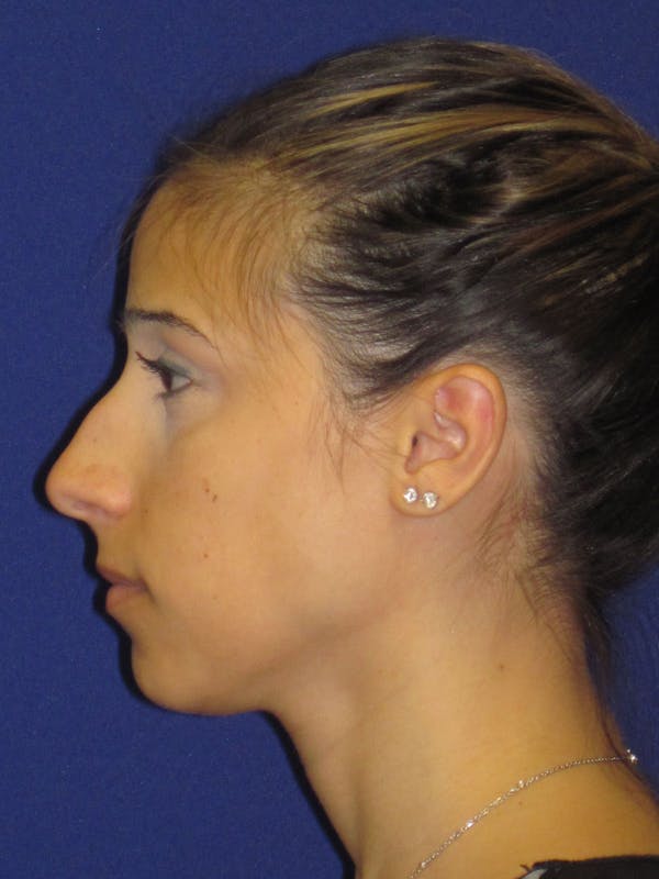 Rhinoplasty Before & After Gallery - Patient 4891319 - Image 1