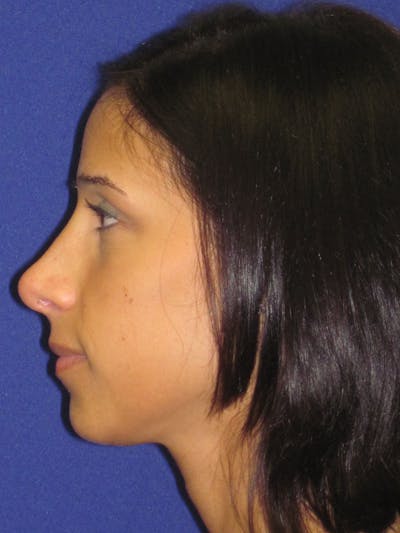 Rhinoplasty Before & After Gallery - Patient 4891319 - Image 2