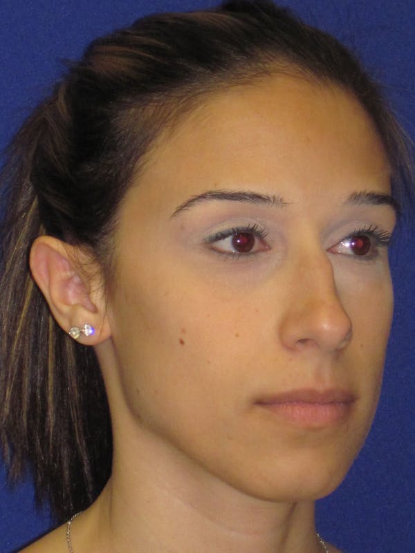 Rhinoplasty Before & After Gallery - Patient 4891319 - Image 3