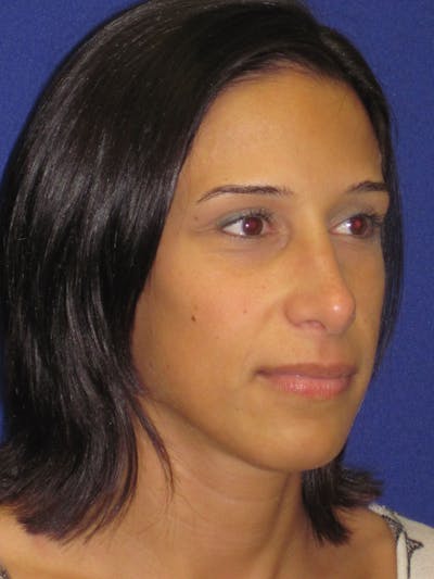 Rhinoplasty Before & After Gallery - Patient 4891319 - Image 4
