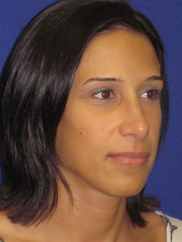 Rhinoplasty Before & After Gallery - Patient 4891319 - Image 4