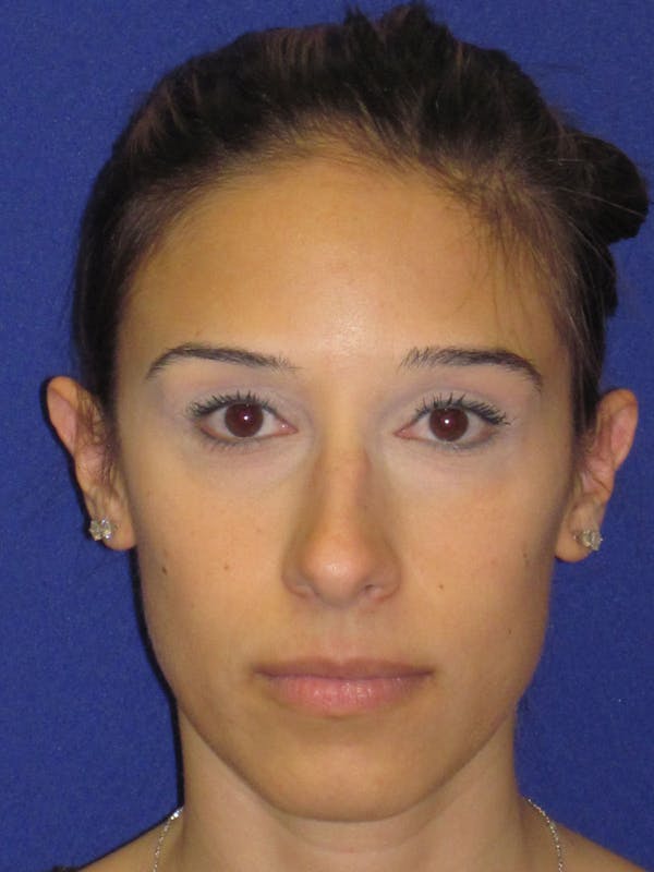 Rhinoplasty Before & After Gallery - Patient 4891319 - Image 5