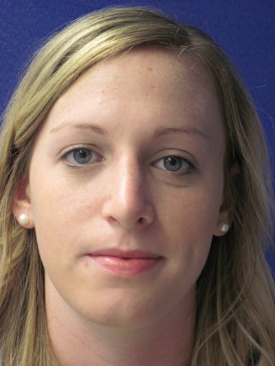 Rhinoplasty Before & After Gallery - Patient 4891321 - Image 2
