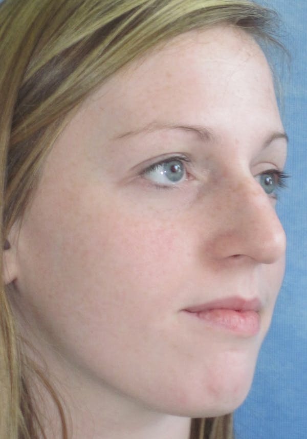 Rhinoplasty Before & After Gallery - Patient 4891321 - Image 3