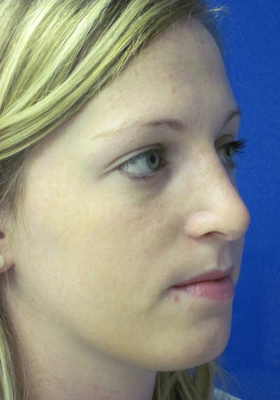 Rhinoplasty Before & After Gallery - Patient 4891321 - Image 4