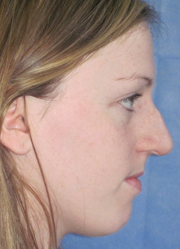 Rhinoplasty Before & After Gallery - Patient 4891321 - Image 5