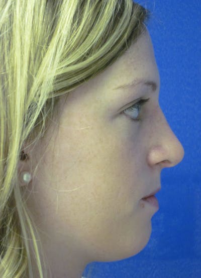 Rhinoplasty Before & After Gallery - Patient 4891321 - Image 6
