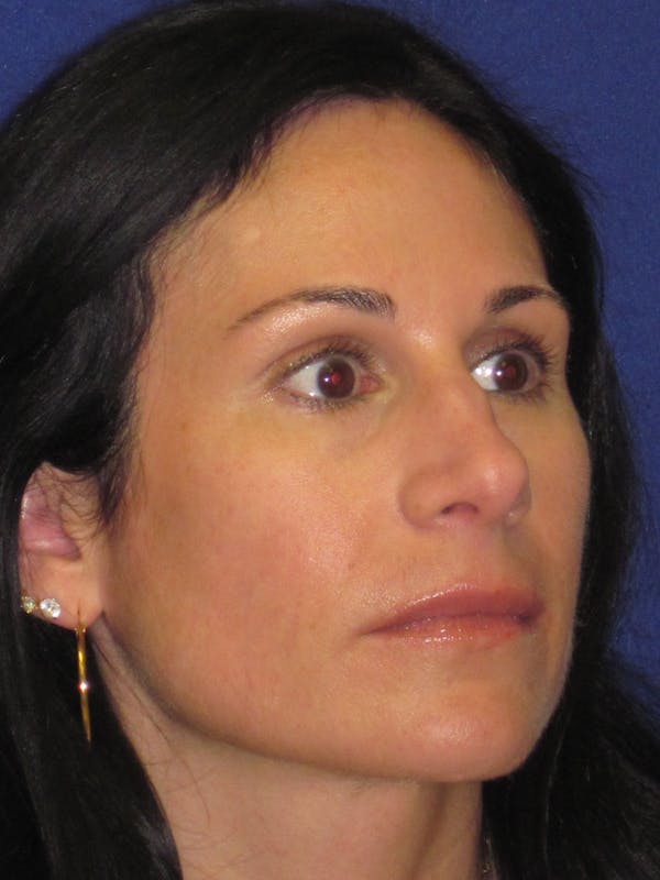 Rhinoplasty Before & After Gallery - Patient 4891323 - Image 3