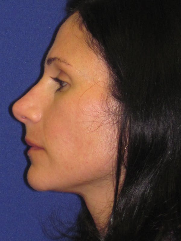 Rhinoplasty Before & After Gallery - Patient 4891323 - Image 5