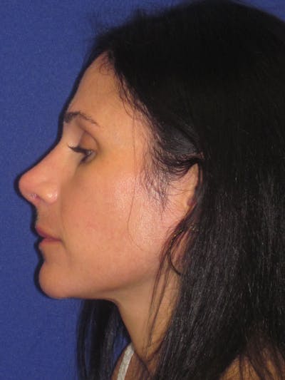 Rhinoplasty Before & After Gallery - Patient 4891323 - Image 6