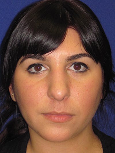 Rhinoplasty Before & After Gallery - Patient 4891324 - Image 1