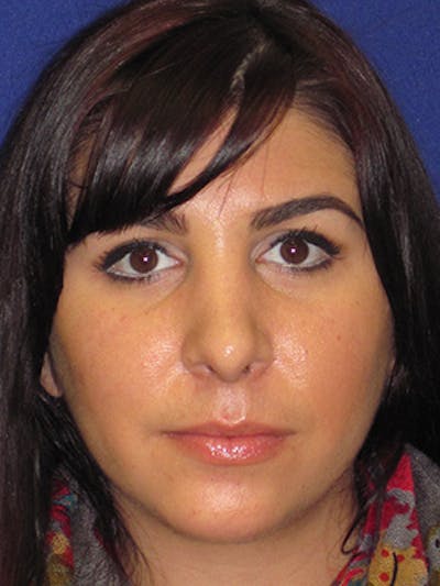 Rhinoplasty Before & After Gallery - Patient 4891324 - Image 2