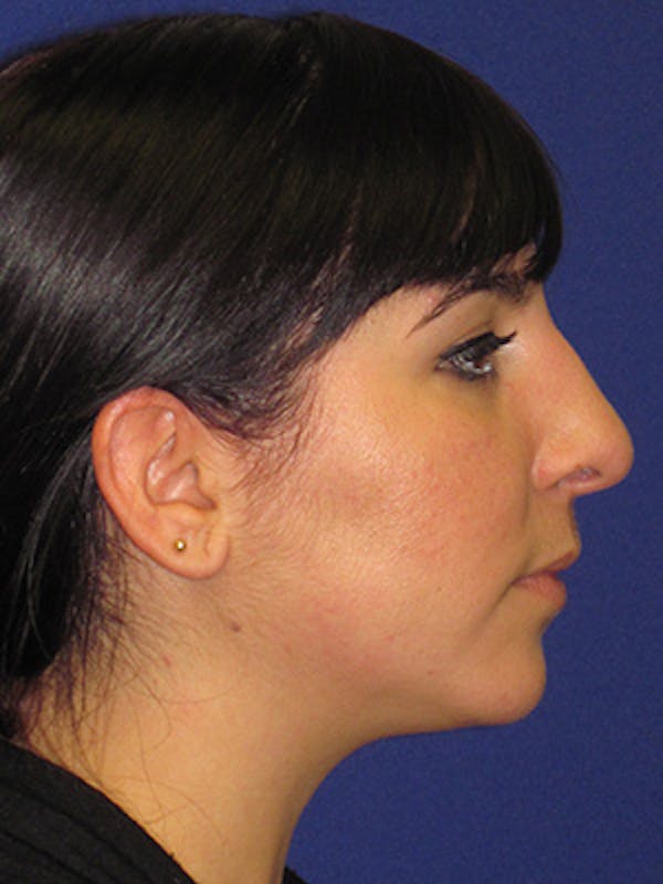 Rhinoplasty Before & After Gallery - Patient 4891324 - Image 3