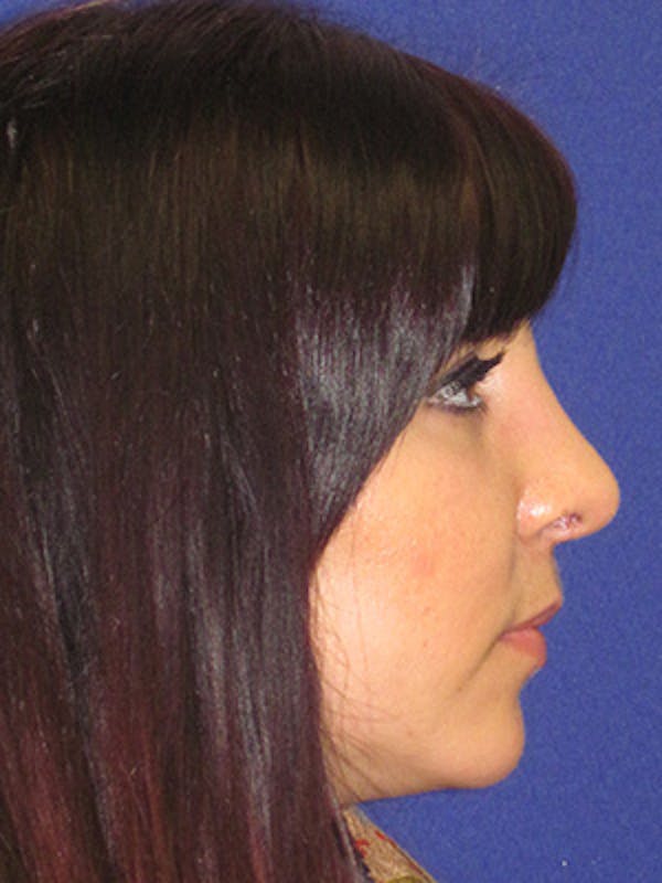 Rhinoplasty Before & After Gallery - Patient 4891324 - Image 4