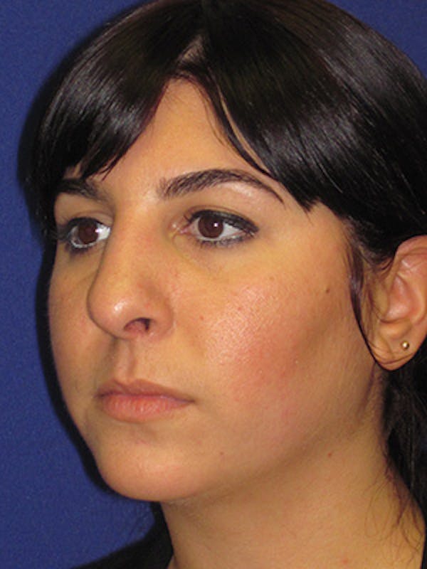 Rhinoplasty Before & After Gallery - Patient 4891324 - Image 5