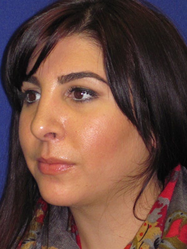 Rhinoplasty Before & After Gallery - Patient 4891324 - Image 6