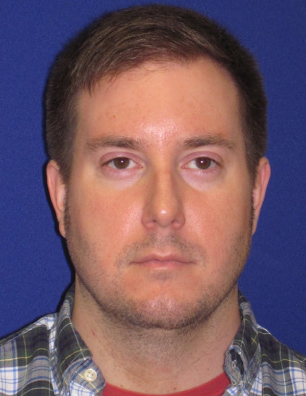 Rhinoplasty Gallery - Patient 4891330 - Image 1