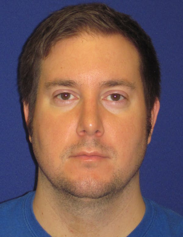 Rhinoplasty Gallery - Patient 4891330 - Image 2