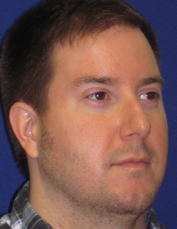 Rhinoplasty Gallery - Patient 4891330 - Image 3