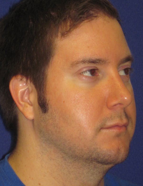 Rhinoplasty Gallery - Patient 4891330 - Image 4