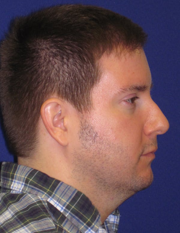 Rhinoplasty Gallery - Patient 4891330 - Image 5