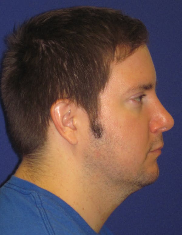 Rhinoplasty Gallery - Patient 4891330 - Image 6
