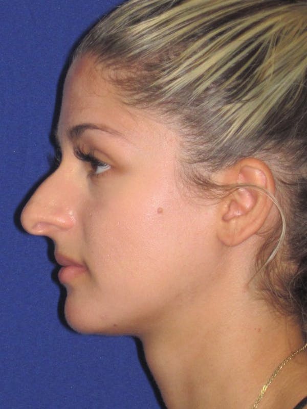 Rhinoplasty Before & After Gallery - Patient 4891331 - Image 1