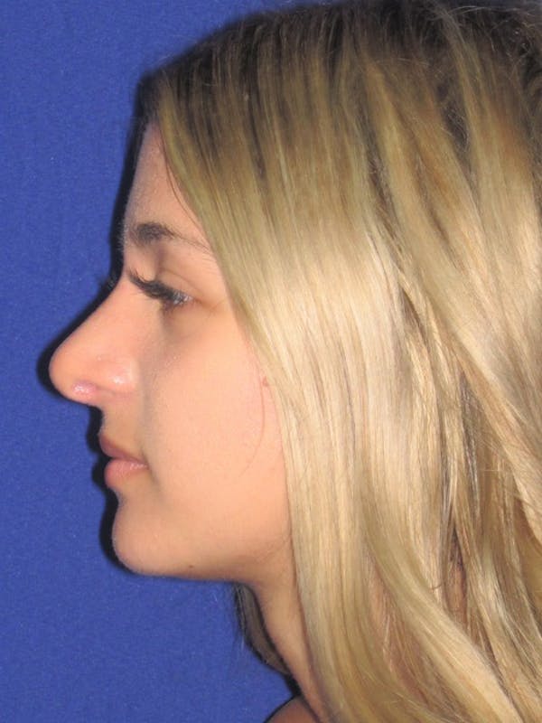 Rhinoplasty Before & After Gallery - Patient 4891331 - Image 2