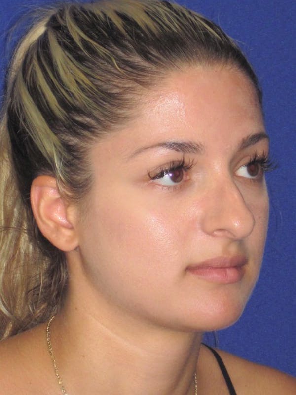 Rhinoplasty Before & After Gallery - Patient 4891331 - Image 3