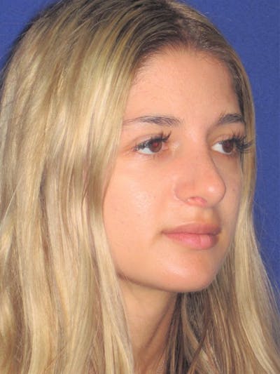 Rhinoplasty Before & After Gallery - Patient 4891331 - Image 4