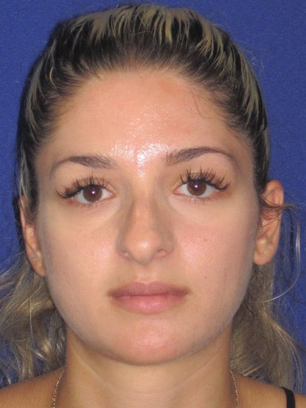 Rhinoplasty Before & After Gallery - Patient 4891331 - Image 5