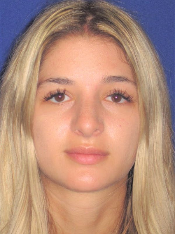 Rhinoplasty Gallery - Patient 4891331 - Image 6