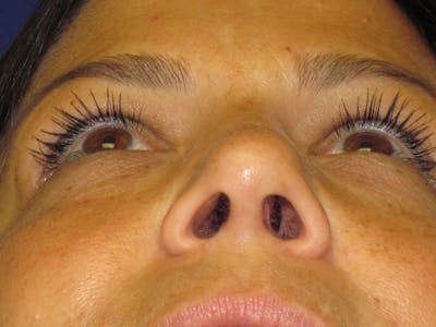 Rhinoplasty Before & After Gallery - Patient 4891334 - Image 4
